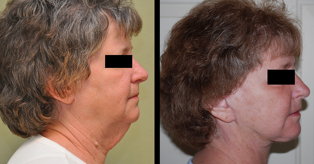 Face Necklift Before and After Photo