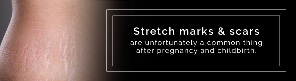 stretch mark and scar removal after birth