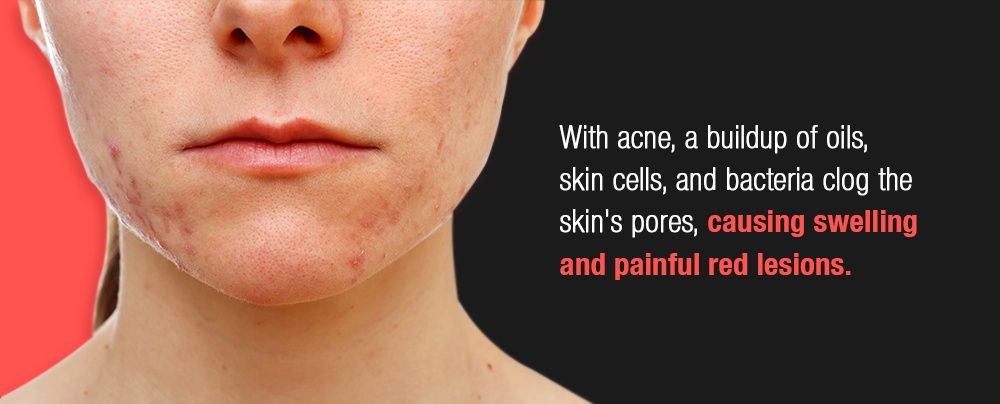 With acne, a buildup of oils, skin cells, and bacteria clog the skin's pores causing swelling and painful red lesions.