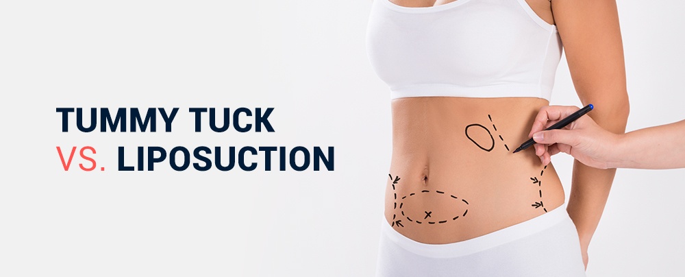 Tummy Tuck VS Liposuction | SPRSI