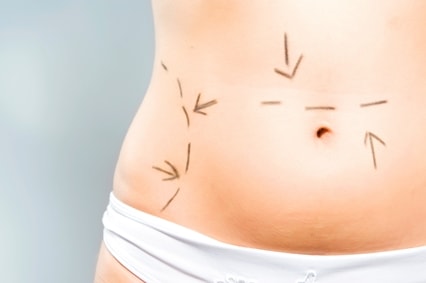 abdominoplasty surgery