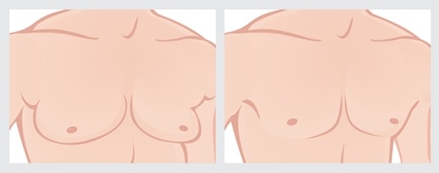 gynecomastia diagram