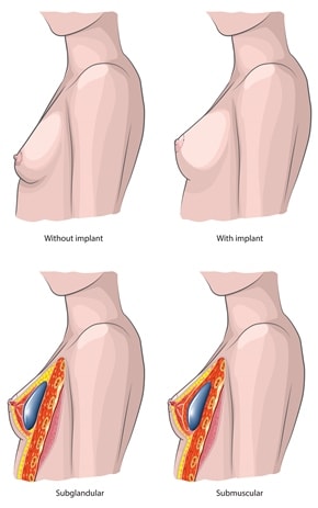 breast implant diagram