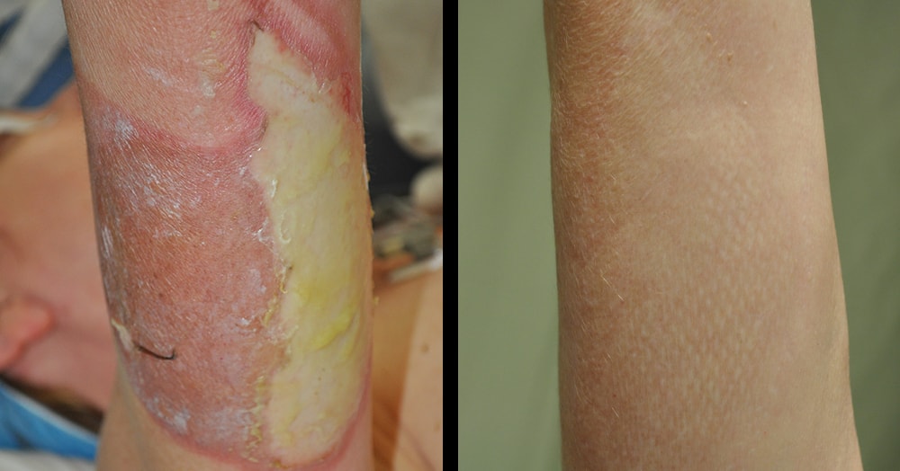 plastic surgery for burns before and after photo