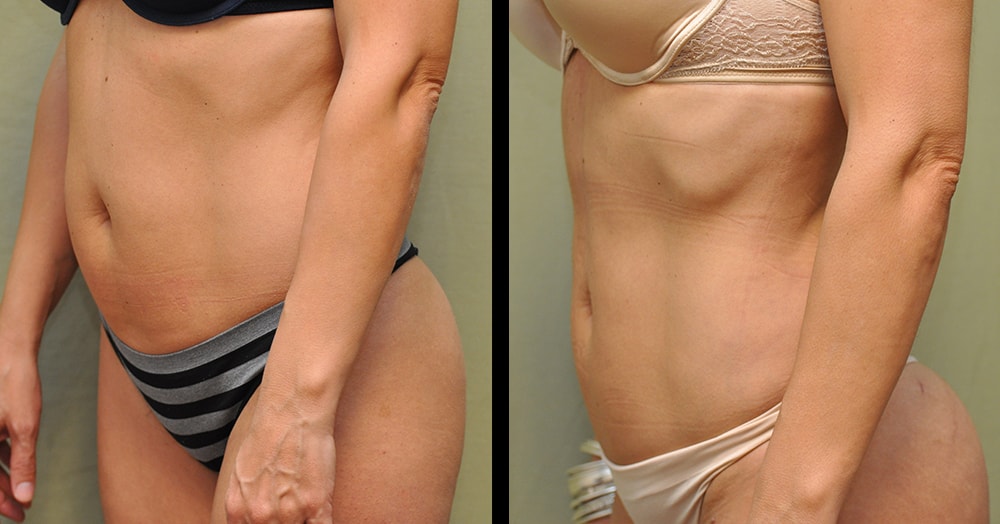 Thigh Lift Before & After Pictures Nashville, Franklin, TN