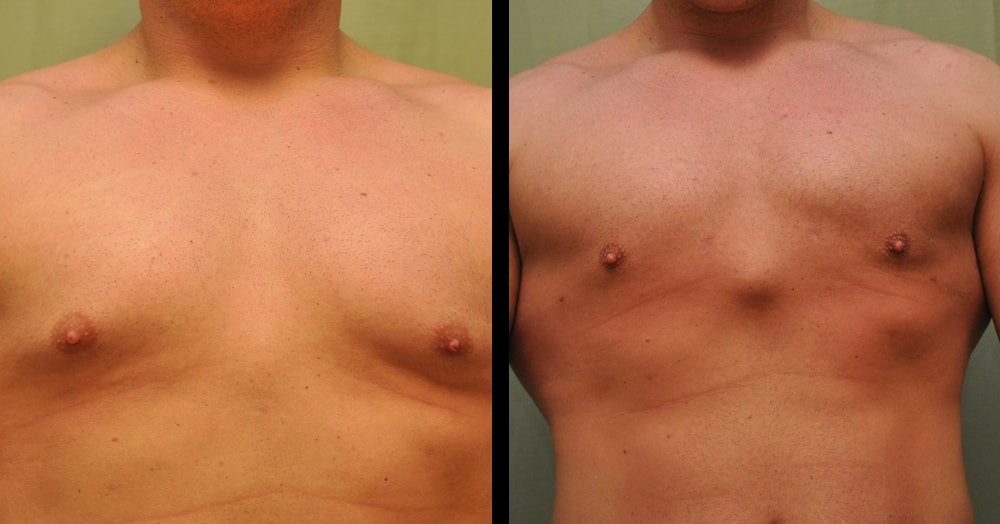 gynecomastia post operation photos