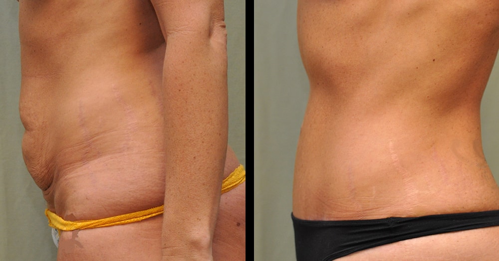 Body tummy tuck before and after