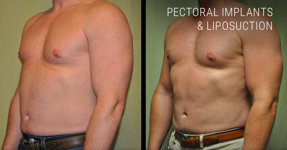 Pectoral implants and lipo before and after
