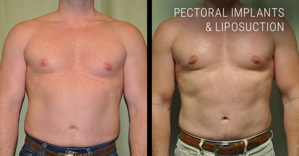 Pectoral implants and lipo before and after