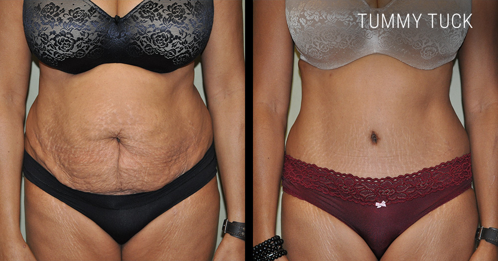 Tummy tuck before and after