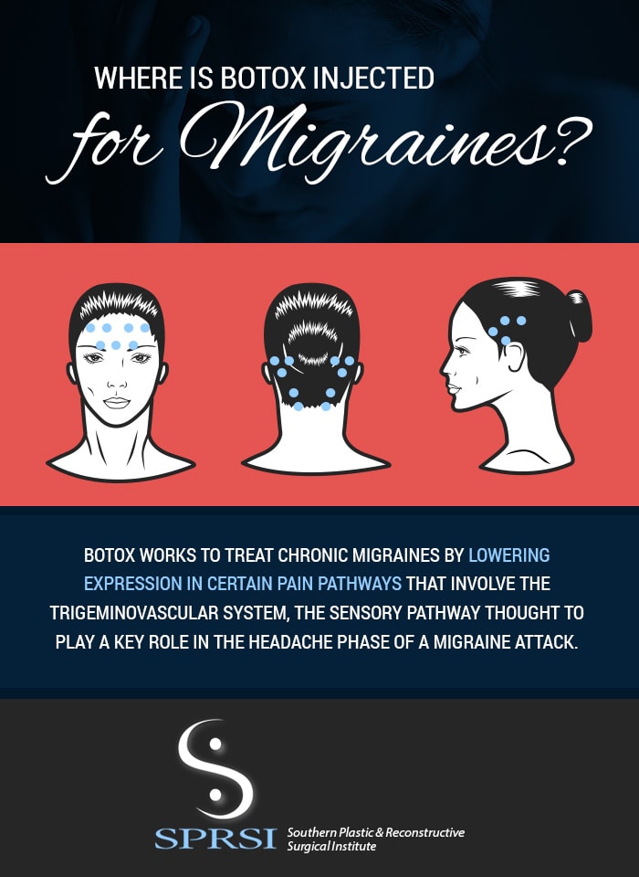 botox for migraines
