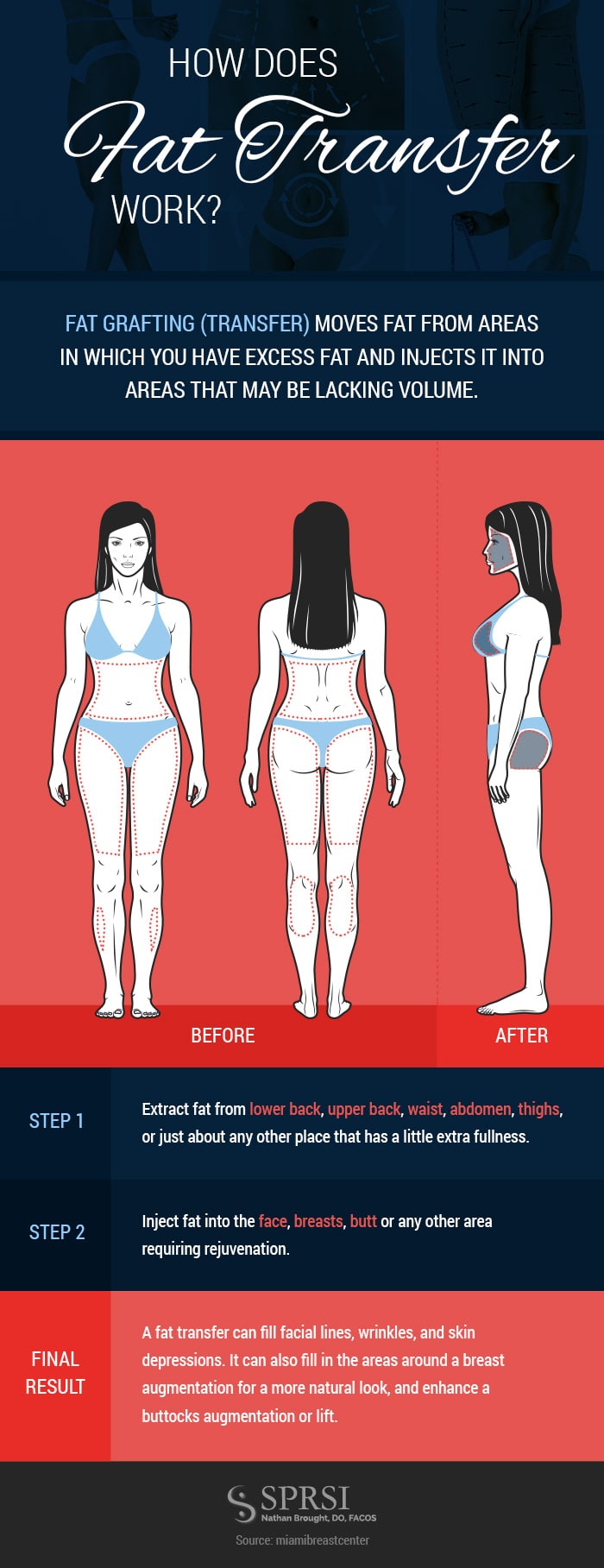 Fat grafting transfer process explained